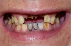 Lười đánh răng có thể làm tăng nguy cơ ung thư dạ dày