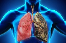 Khi nào cần tầm soát ung thư phổi?