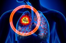 5 thói quen nên duy trì để bảo vệ lá phổi của bạn mỗi ngày