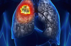 Biểu hiện bệnh ung thư phổi ở từng giai đoạn