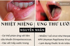 Nhiệt miệng và ung thư lưỡi: Triệu chứng dễ nhầm lẫn, làm thế nào để phân biệt?