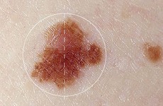 Nhận biết chính xác dấu hiệu ung thư da dựa vào sự bất thường của nốt ruồi