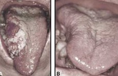 Ung thư lưỡi: phân loại, dấu hiệu, chẩn đoán và cách phòng tránh