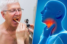 Khả năng chữa trị của ung thư vòm họng giai đoạn 2 là bao nhiêu phần trăm?