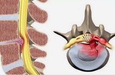 Hiểu đúng về thoát vị đĩa đệm và những loại thoát vị đĩa đệm thường gặp