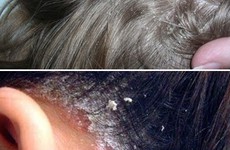 5 bí kíp trị nấm da đầu hiệu quả từ thiên nhiên