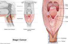 Các giai đoạn của ung thư thanh quản 