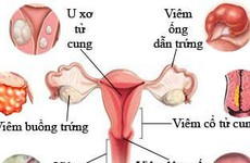 5 dấu hiệu nhận biết bệnh phụ khoa nguy hiểm