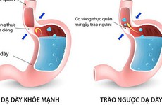 Những câu hỏi thường gặp về trào ngược dạ dày thực quản ở trẻ