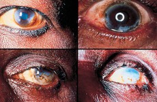 Sốc: 10 bệnh ký sinh trùng ở mắt có thể gây mù vĩnh viễn