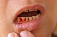 Chảy máu chân răng là dấu hiệu của bệnh gì?