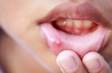 Ung thư miệng: dấu hiệu, nguyên nhân, cách điều trị và phòng tránh