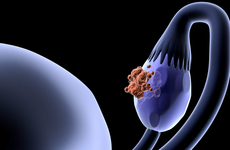Ung thư buồng trứng: Nguyên nhân, triệu chứng, các giai đoạn, chẩn đoán và điều trị