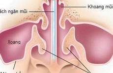 Bệnh vẹo vách ngăn mũi là gì? dấu hiệu nhận biết và cách điều trị vẹo vách ngăn mũi