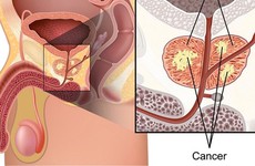 Các giai đoạn của bệnh ung thư tuyến tiền liệt