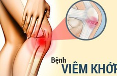 Nguyên nhân và triệu chứng bệnh viêm khớp - Những điều bạn nên biết