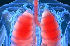 Mối liên hệ giữa viêm phổi cộng đồng và thời điểm giao mùa