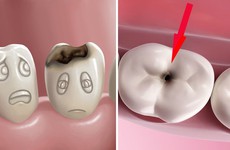 Viêm tuỷ răng là gì và các giai đoạn của bệnh?