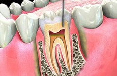 Phương pháp điều trị viêm tuỷ răng tại nhà 