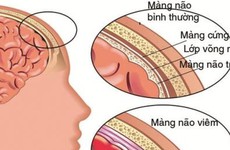 Khi nào biến chứng của bệnh tay chân miệng xuất hiện?