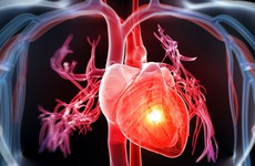 Phòng ngừa thiếu máu cơ tim để bảo vệ tính mạng của mình