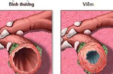 Viêm phế quản cấp là gì và những nguyên nhân gây bệnh