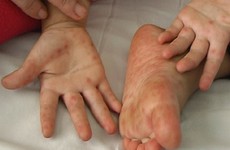 Những điều bố mẹ cần biết về bệnh tay chân miệng ở trẻ