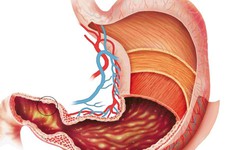 Các nguyên nhân trào ngược dạ dày phổ biến