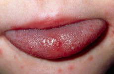 Tay chân miệng và thủy đậu: Triệu chứng tương đồng dễ gây nhầm lẫn