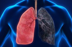 Các câu hỏi thường gặp về bệnh phổi tắc nghẽn mãn tính (COPD)