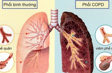 Bệnh phổi tắc nghẽn mãn tính là gì? Dấu hiệu, nguyên nhân, biến chứng và phương pháp điều trị