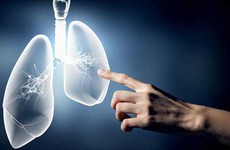 Phòng ngừa bệnh phổi tắc nghẽn mãn tính như thế nào?
