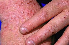 6 Điều cần biết về bệnh eczema