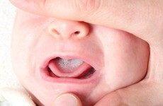 Nấm họng là gì và những điều cần biết về bệnh nấm họng