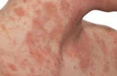 Bệnh chàm eczema là gì?