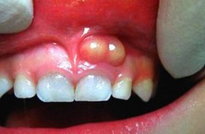  Áp xe răng: Mức độ nguy hiểm và cách điều trị