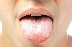 Giải đáp thắc mắc liên quan đến câu hỏi: Lưỡi trắng bệnh gì?