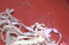 Bệnh sán dây và cách phòng tránh căn bệnh ký sinh trùng đáng sợ