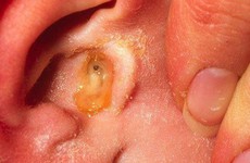 Cần phát hiện sớm bệnh viêm tai thanh dịch để phòng tránh những biến chứng nguy hiểm