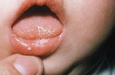 Nấm miệng trẻ sơ sinh: Nguyên nhân và cách điều trị