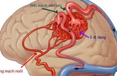 Bệnh dị dạng mạch máu não có thể gây đột tử không?