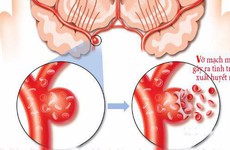 Dị dạng mạch máu não là gì?