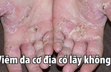 Viêm da cơ địa có lây không? Câu trả lời cho những ai thực sự quan tâm