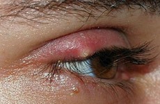 Cứ nghĩ mi mắt bị ngứa bình thường, ai ngờ đã mắc bệnh viêm bờ mi