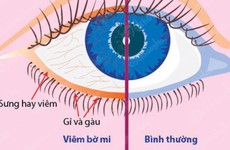 Khi mi mắt có gàu, cần nghĩ ngay đến dấu hiệu viêm bờ mi