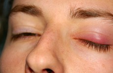 Các cách chữa viêm bờ mi mắt và thực phẩm hỗ trợ
