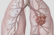 Ung thư vú di căn phổi là gì? Cơ chế lây lan, dấu hiệu nhận biết, điều trị và tiên lượng sống