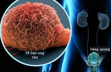 Ung thư bàng quang: Hình ảnh, dấu hiệu và phương pháp điều trị