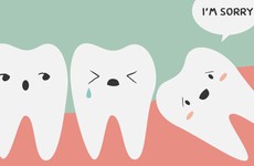 Triệu chứng mọc răng khôn và lời khuyên của bác sĩ
