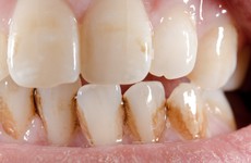 9 nguyên nhân khiến răng bị ố vàng, xỉn màu